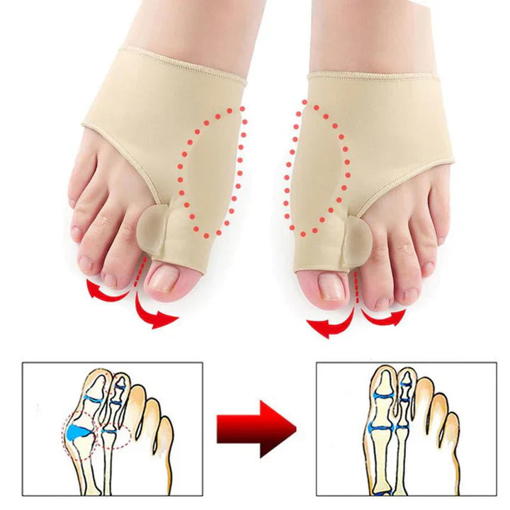 Protection de Correction de L' Hallux - Valgus (1 Paire)