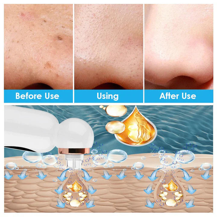 Extracteur de Points Noirs et Appareil D' Hydrodermabrasion