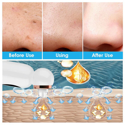 Extracteur de Points Noirs et Appareil D' Hydrodermabrasion